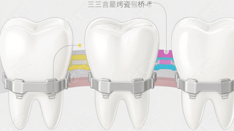 小白兔口腔镶全瓷牙冠价格