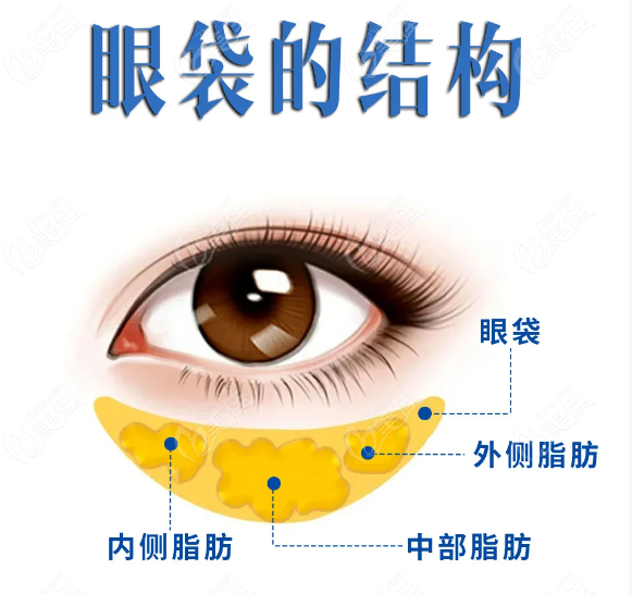 选择微创无痕去眼袋的优势和注意事项