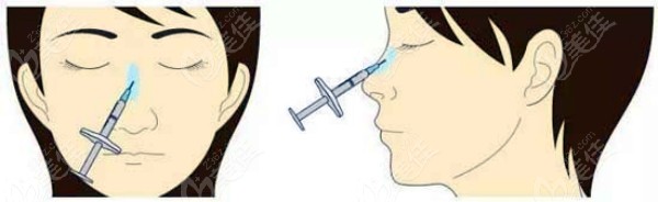 陈向东注射爱贝芙的价格