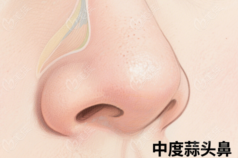 爱贝芙注射隆鼻