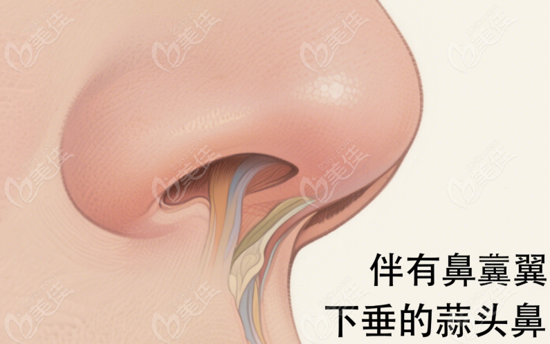 爱贝芙注射蒜头鼻