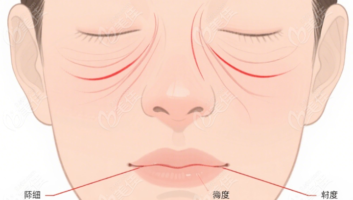 注射奥美定取出术后