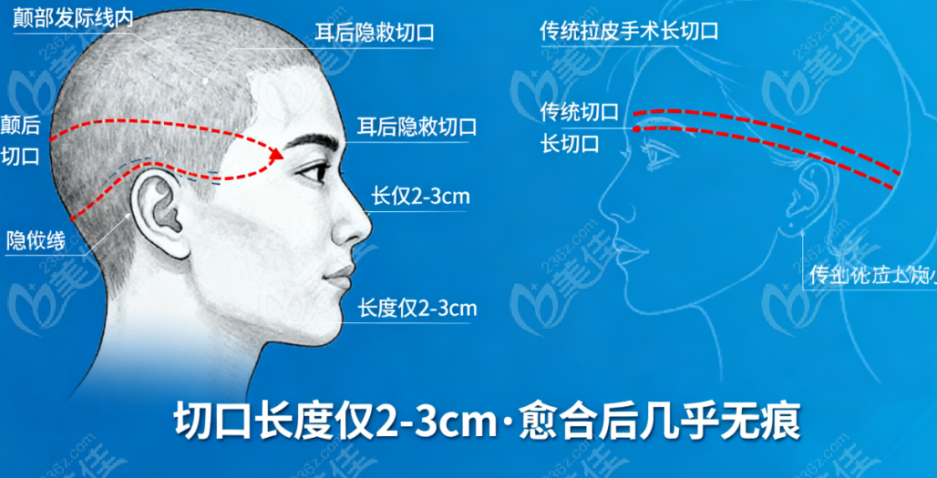 成都宋华敬和侯典举拉皮谁好