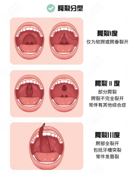 广州余文林和毛喆唇裂手术哪个好