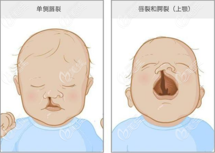 余文林唇裂修复过程是怎样的