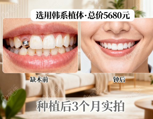 牙谷种植牙