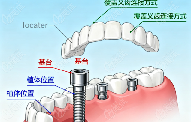 locator种植覆盖式义齿