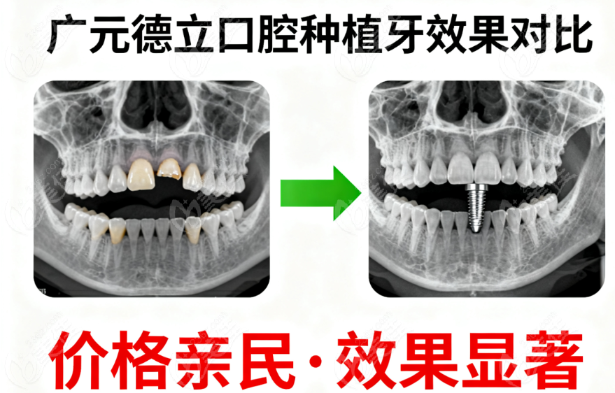 广元德立口腔医院植牙