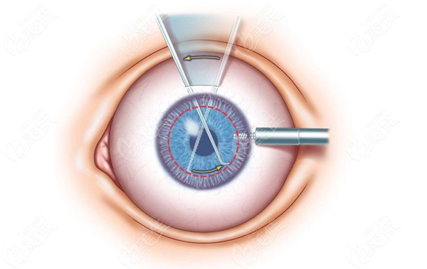 南昌華廈眼科醫(yī)院收費(fèi)價(jià)格影響因素