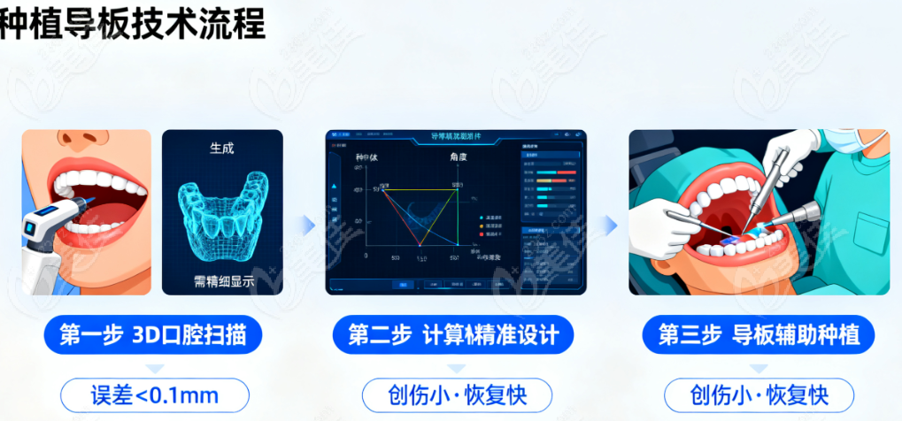 日照未来口腔数字化种植导板
