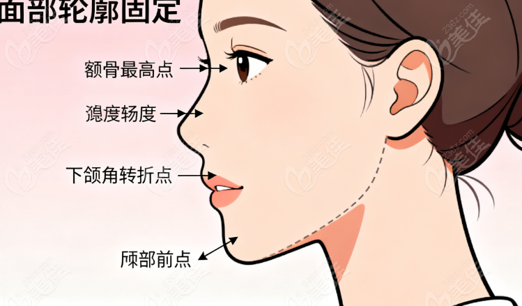 于飞多维轮廓固定