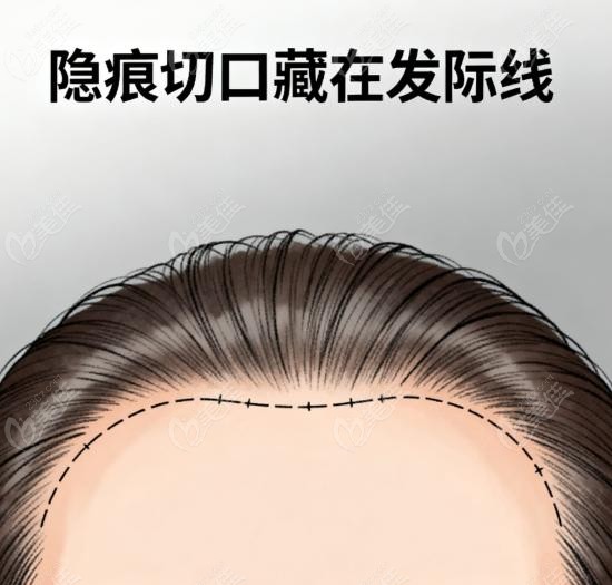 赵延勇眼周筋膜悬吊多少钱