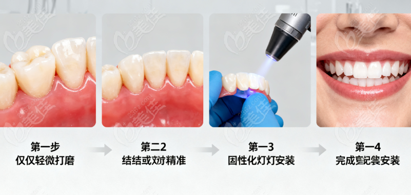 芬力粘结桥操作流程