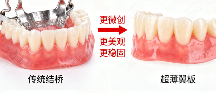 芬力粘结桥耐用性