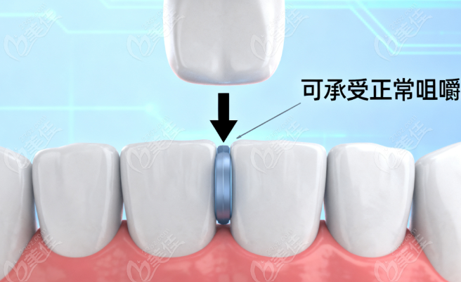 芬力粘结桥5大质疑