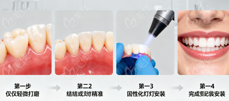 芬力粘结桥属于新技术吗