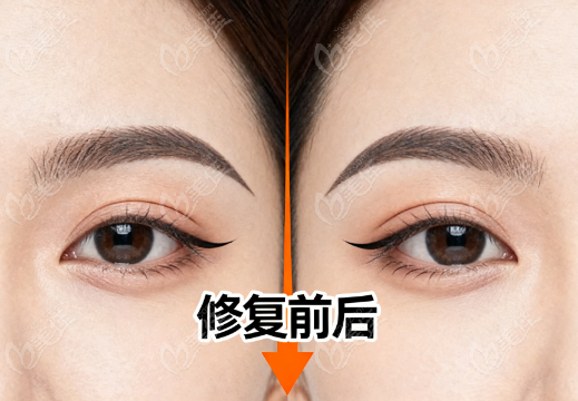 成都韩春双眼皮修复对比图