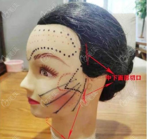 真实患者反馈陈建忠拉皮手术零失败