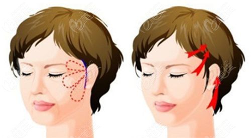 陈建忠医生拉皮价格4万起