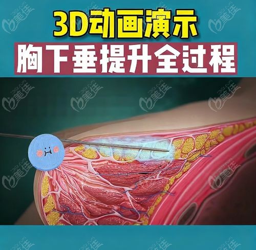 李建东维维胸部提升面诊当天要注意什么