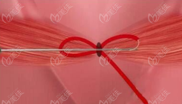 重慶星榮女性私密整形：陰道緊縮術(shù)重塑親密自信