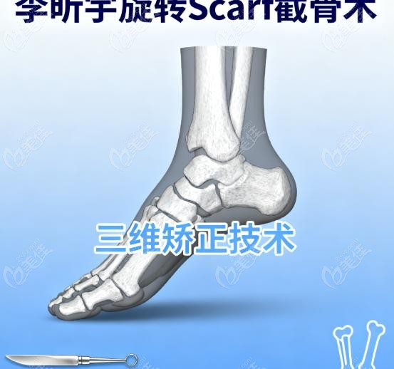 李昕宇拇外翻旋转scarf截骨术