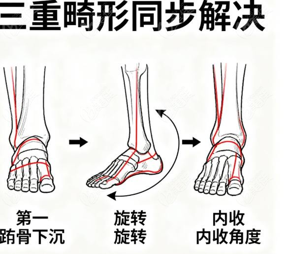 李昕宇旋转Scarf截骨术，如何三维立体“拆弹”