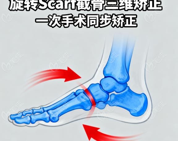 旋转Scarf VS 传统手术，三维矫正强在哪