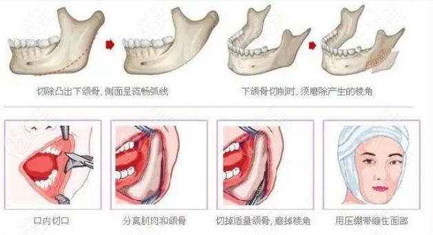 刘正茂医生：颌面整形界的有名的大拿
