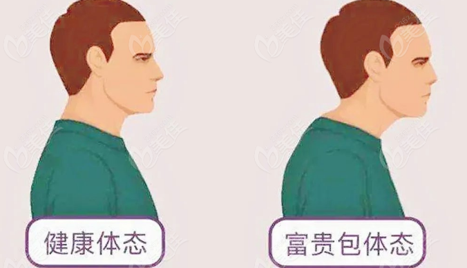 富贵包手术价格大揭秘