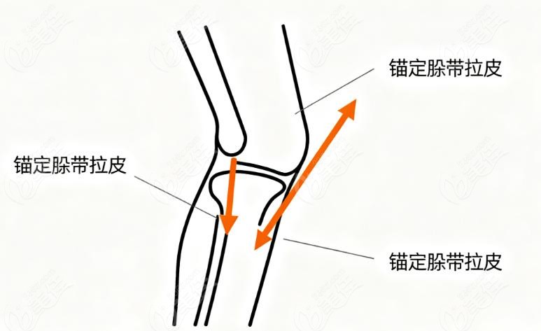 张海明筋膜提升术后不僵硬