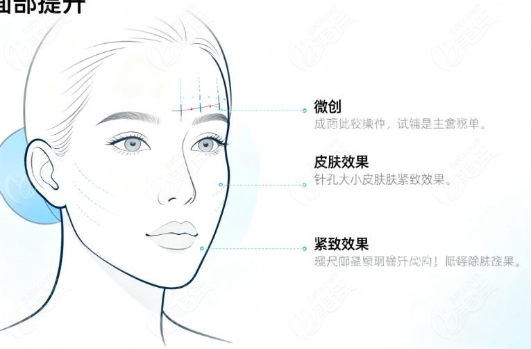 张海明擅长整形一：锚定韧带拉皮术