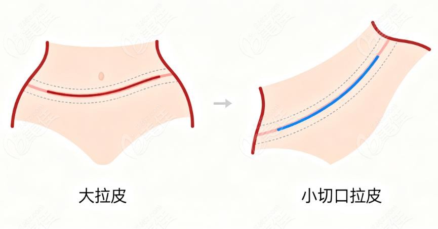 谢宏彬和赵延勇谁的拉皮技术好