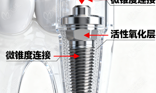 缔杰种植体属于什么档次