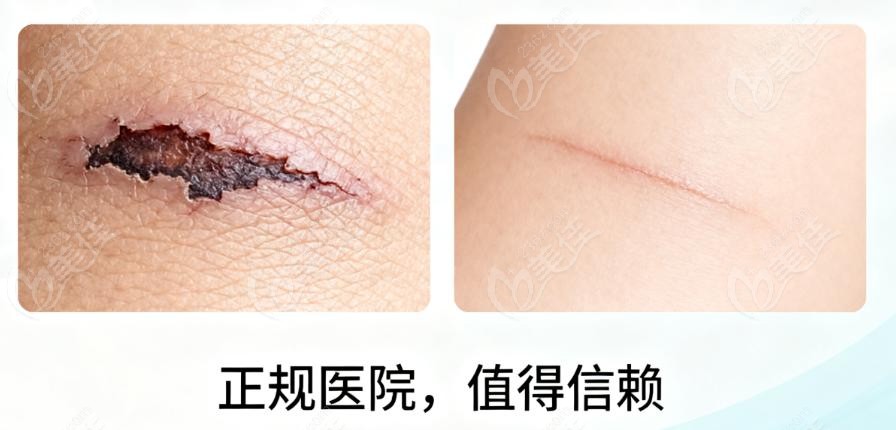 疤痕治疗