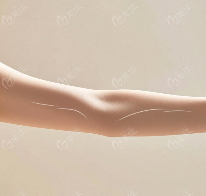 大連沙醫(yī)生手臂吸脂術后自然