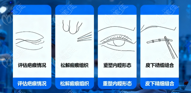 王振军双眼皮手术真的腻害