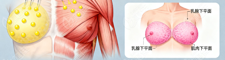 刘成胜取假体加脂肪丰胸价格表