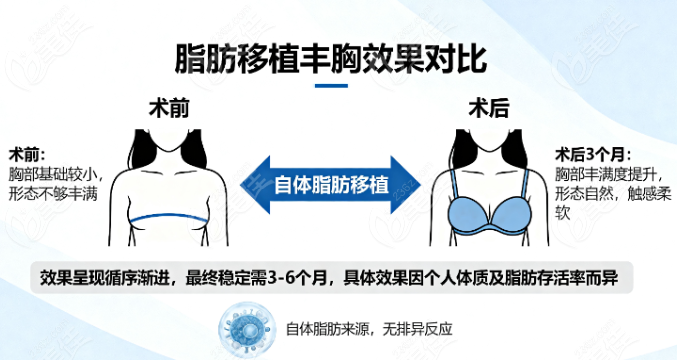 刘成胜取假体加脂肪丰胸成效
