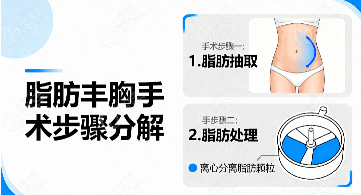 刘成胜产后萎缩脂肪丰胸