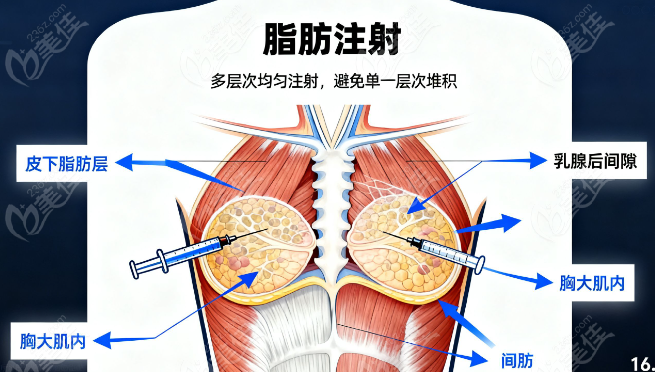 刘成胜产后萎缩脂肪丰胸技术怎么样