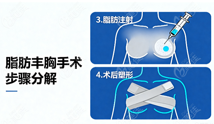 刘成胜产后萎缩脂肪丰胸步骤