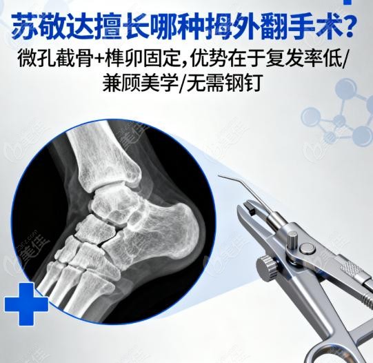 苏敬达擅长哪种拇外翻手术