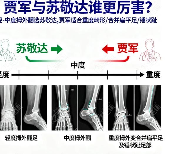 苏敬达：轻-中度拇外翻的“守护神”