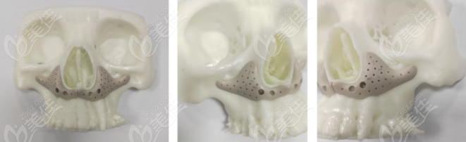 3D PEEK材料鼻基底填充切口位置揭秘