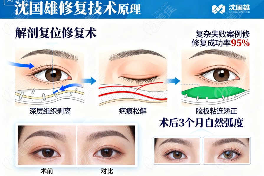 沈国雄双眼皮修复