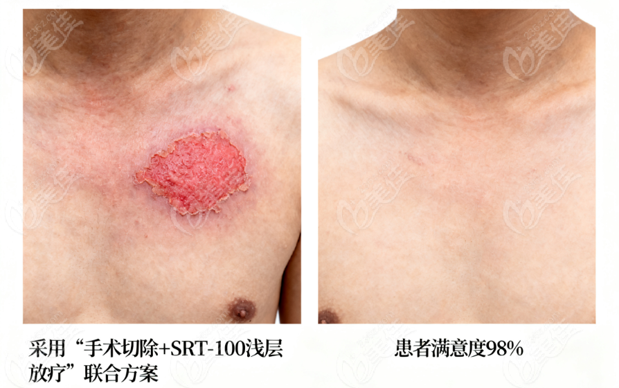 深圳鵬程醫院疤痕修复