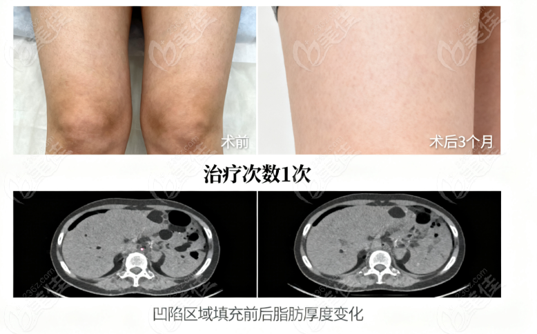 北京王东修复吸脂凹陷技术