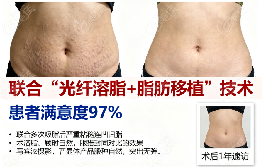 北京王东吸脂