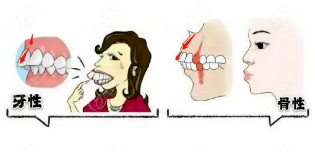 肖林正頜手術(shù)凸嘴不用正畸吧 肖林正頜手術(shù)凸嘴不用正畸吧